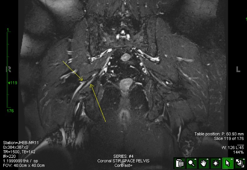 Figure 6 for case split right sciatic